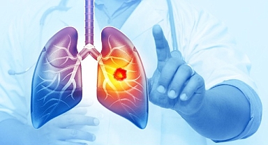 Her Yıl 25 Bin Akciğer Kanseri Vakası Önlenebilir